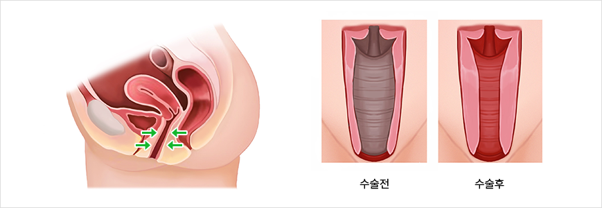 수술전후