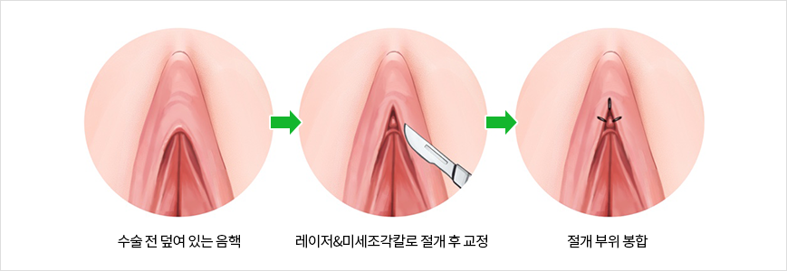 수술전