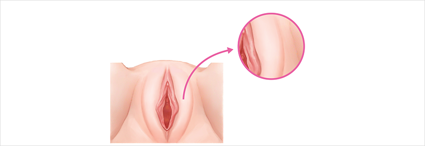 대음순 성형