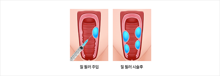 질필러