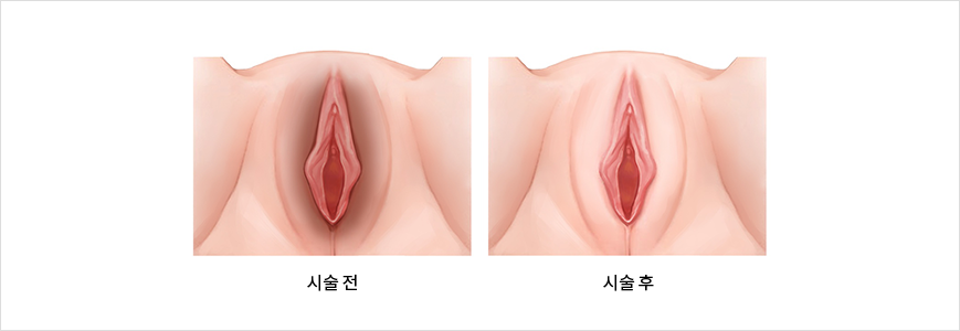 질필러