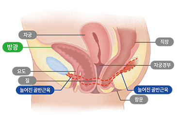 방광탈출증
