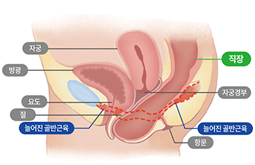직장탈출증