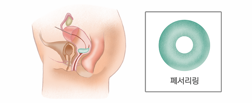 페서리 링 삽입술
