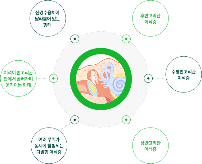 이석증의 종류 이미지