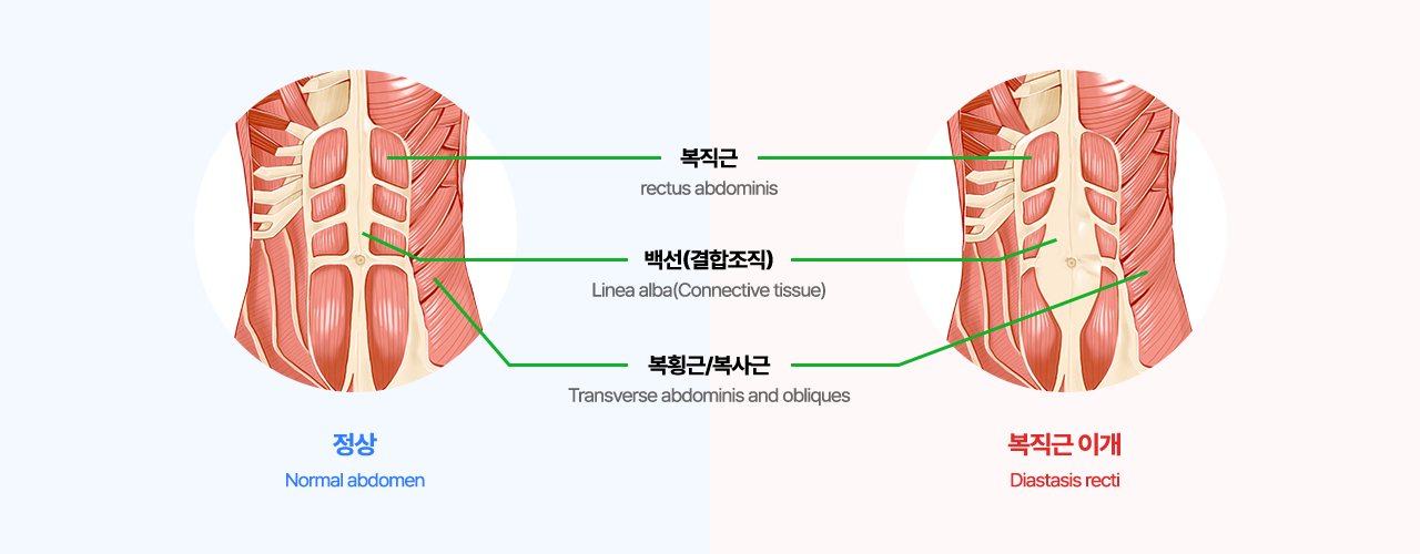 정상과 복직근 이개의 비교 이미지 입니다. 이미지 상으로 복직근(rectus abdominis), 백선(결합조직)(Linea alba(Connective tissue)), 복횡근/복사근(Transverse abdominis and obliques)이 구분되어있습니다.