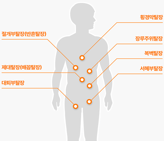 탈장의 발생 부위 이미지