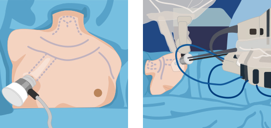 SPRA 단일공 로봇 한쪽 유륜을 통한 갑상선암 수술 이미지