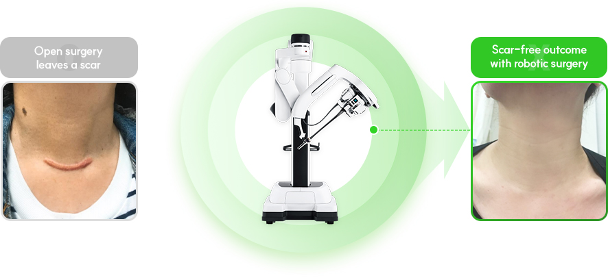 절개 수술 시 흉터 발생, 로봇 수술 시 흉터 없음