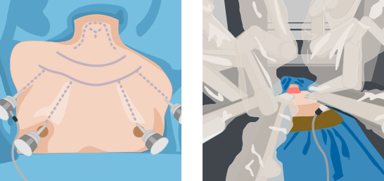 BABA 로봇, 양측 겨드랑이 통한 갑상선암 수술 이미지