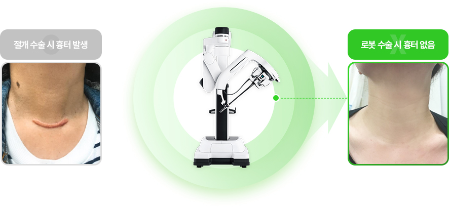 절개 수술 시 흉터 발생, 로봇 수술 시 흉터 없음